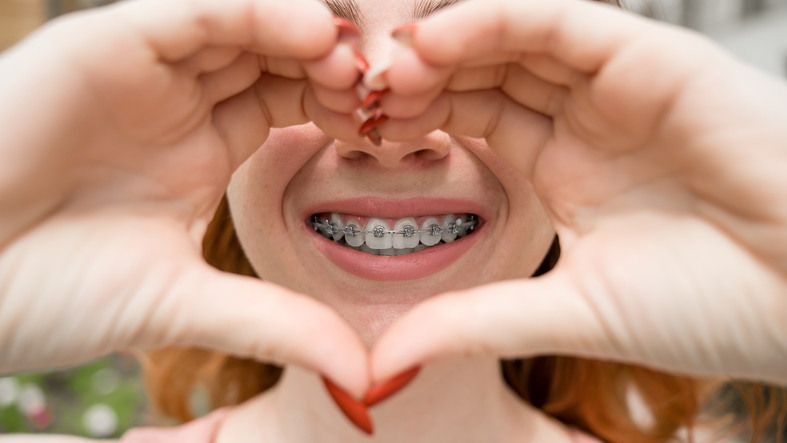 brackets autoligables