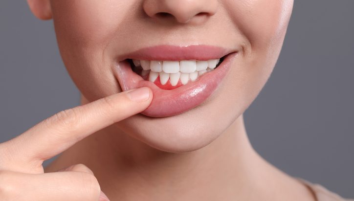 mantenimiento periodontal
