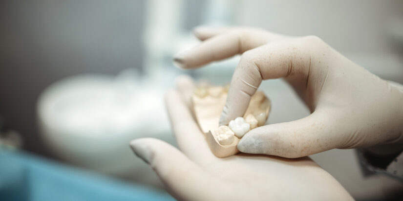 cuánto tiempo duran los implantes dentales