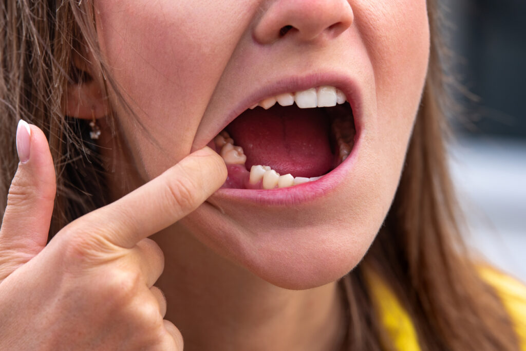 consecuencias de la falta de dientes