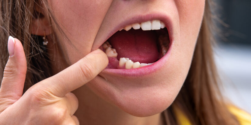 consecuencias de la falta de dientes