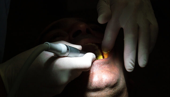 desgaste dental