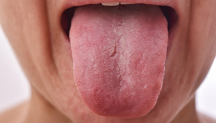 lengua fisurada